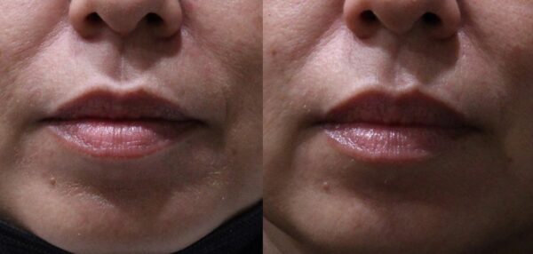 LIP+FLIP+FRONT