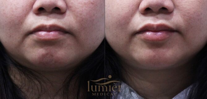 Dimpled chin before and after Botox treatment showing smoother chin texture and reduced muscle contraction.