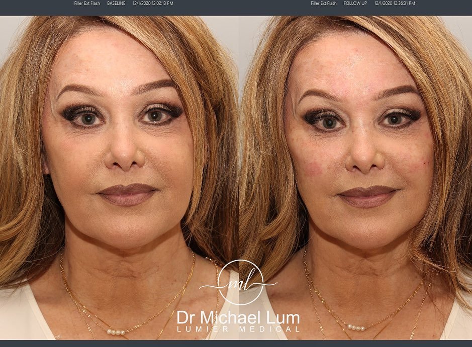 dr-lumvoluma-cheek-filler-before-and-after-torrance-2